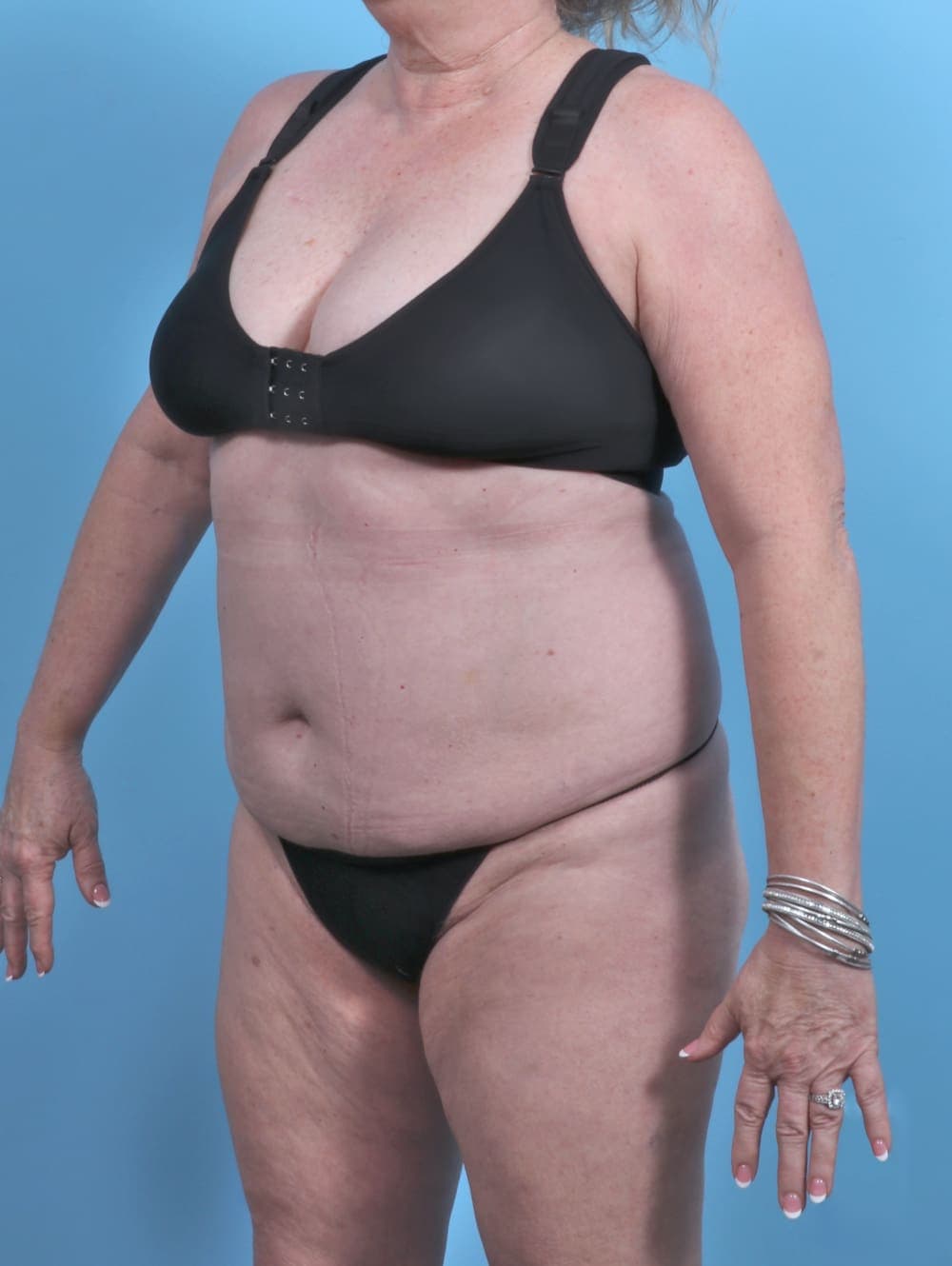 Liposuction case #5592 before, image 3