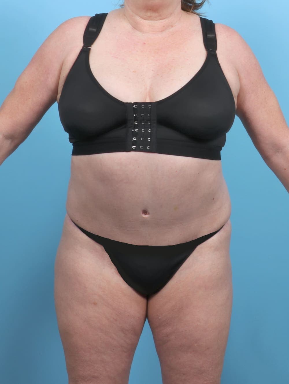 Liposuction case #5592 after, image 1