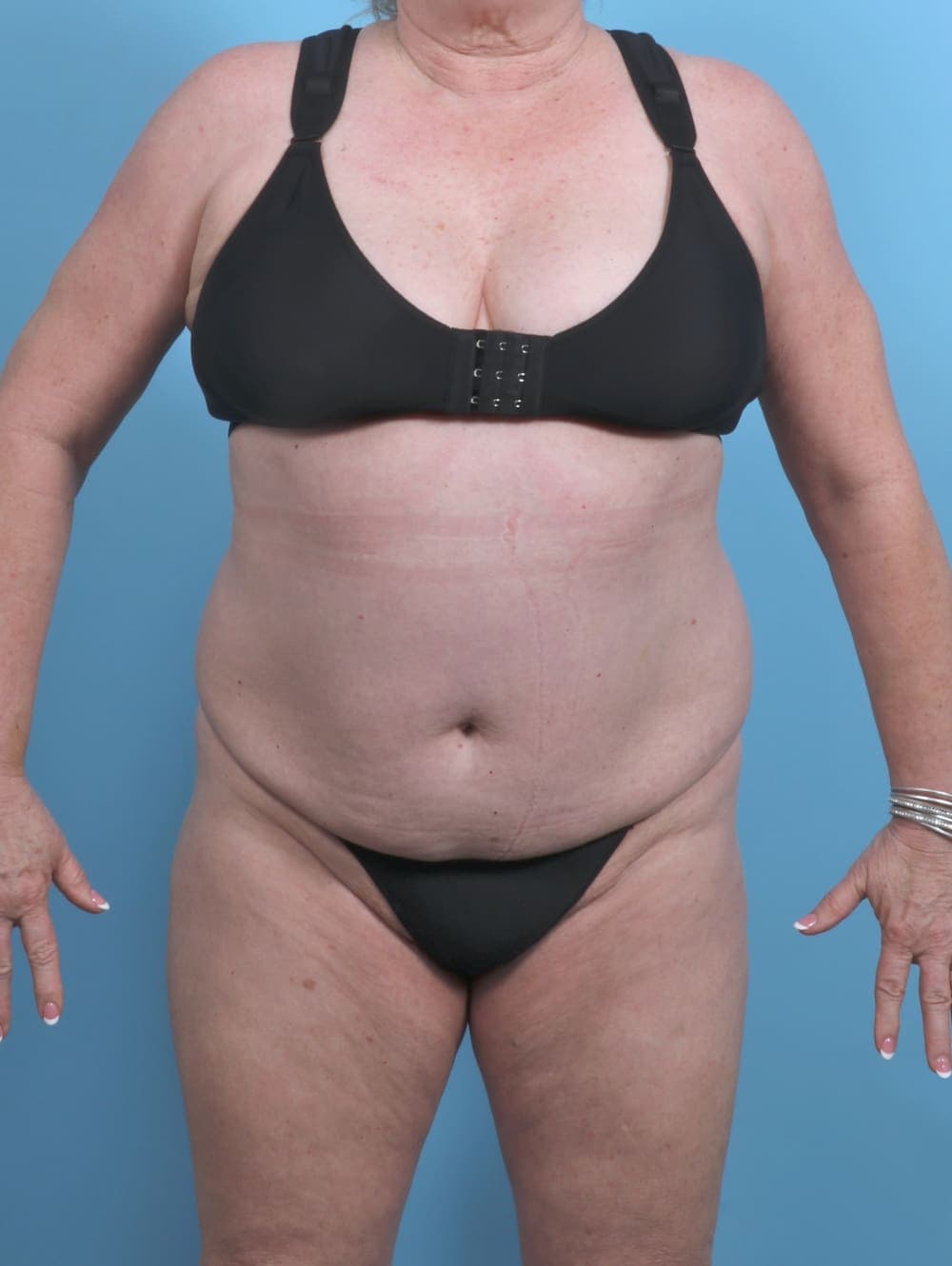Liposuction case #5592 before, image 1
