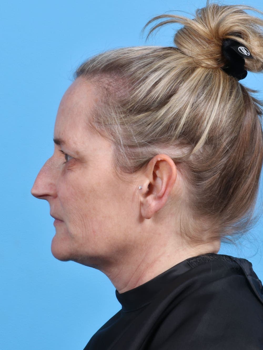 Eyelid Surgery case #3675 before, image 3