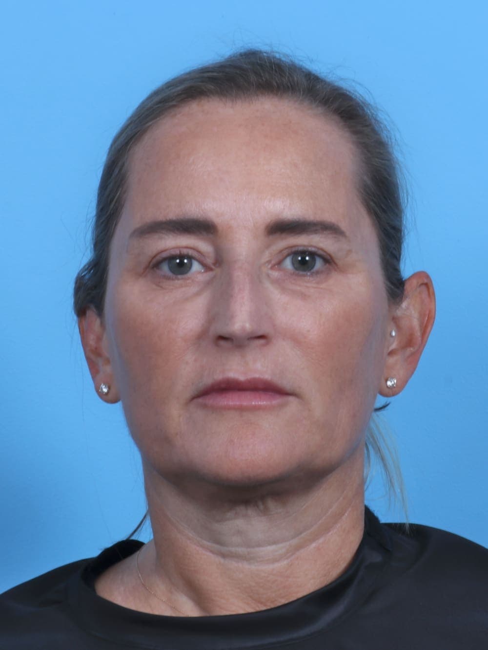 Eyelid Surgery case #3675 after, image 1