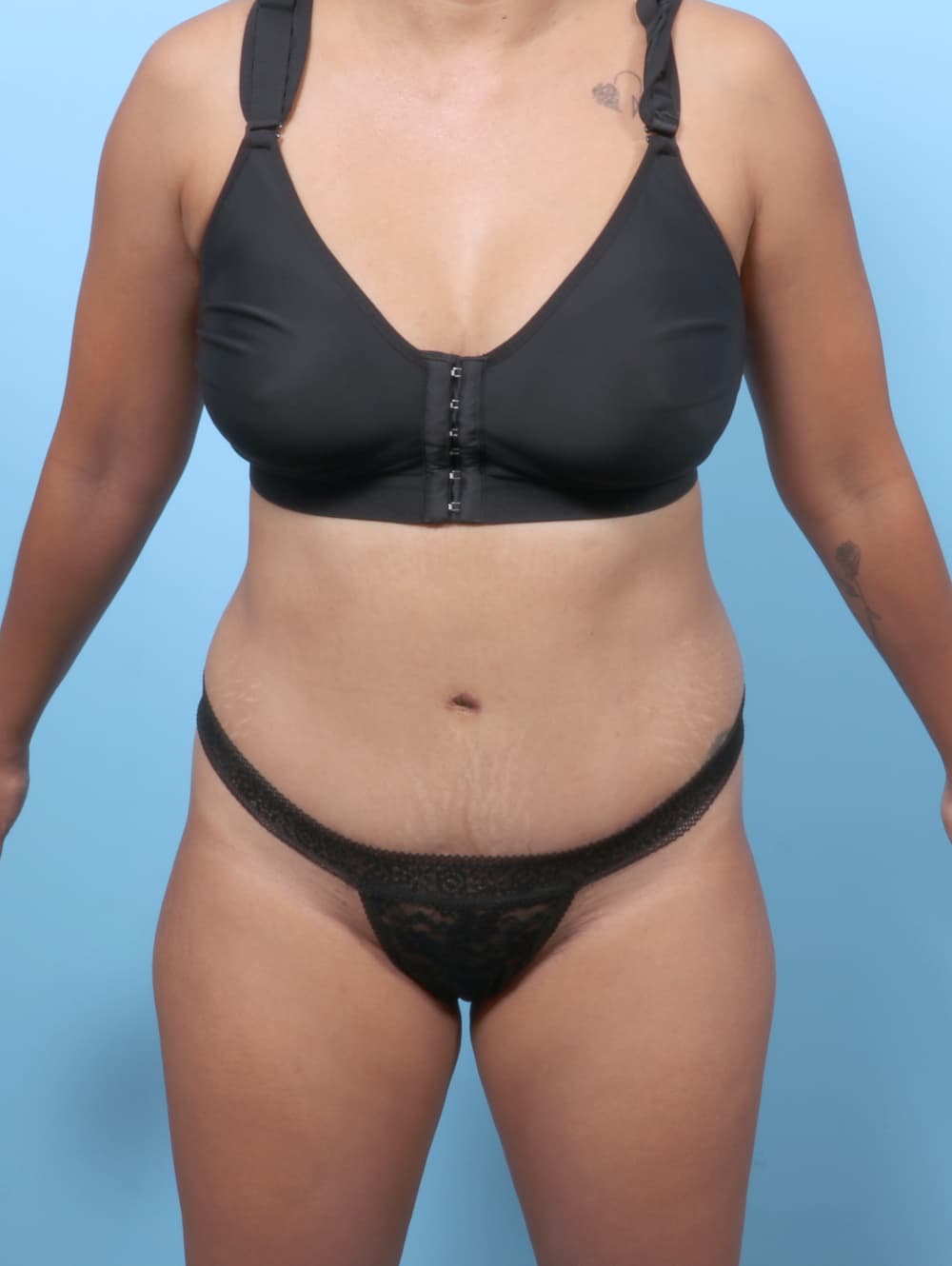 Tummy Tuck case #8338 after
