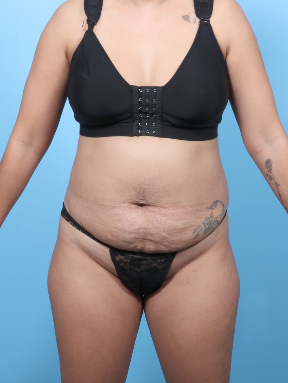 Tummy Tuck case #8338 before