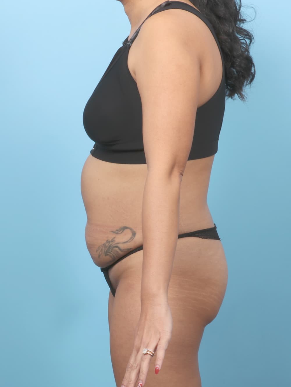 Tummy Tuck case #8338 before, image 3