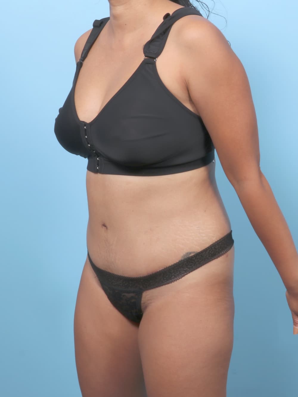 Tummy Tuck case #8338 after, image 2