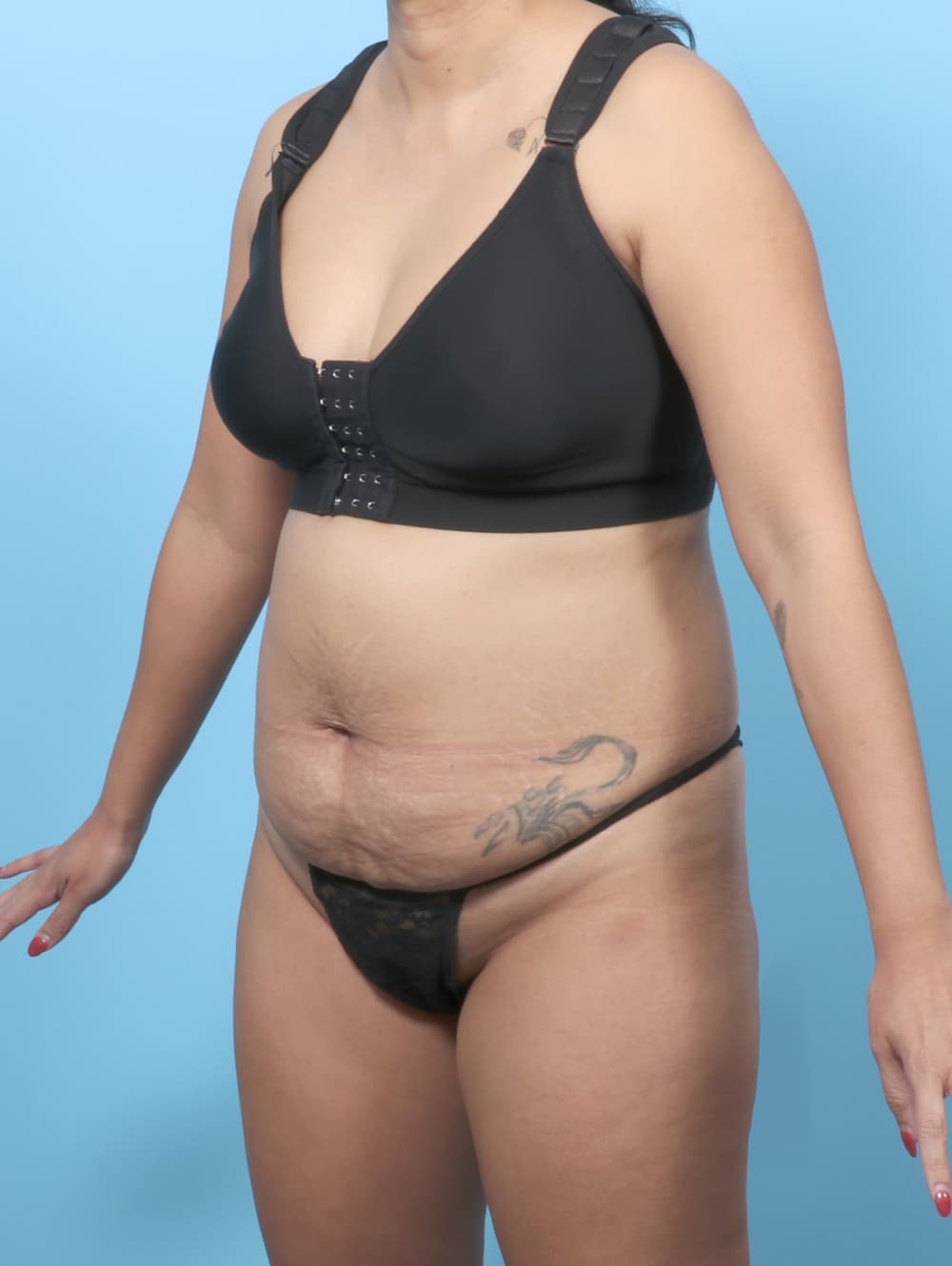 Tummy Tuck case #8338 before, image 2