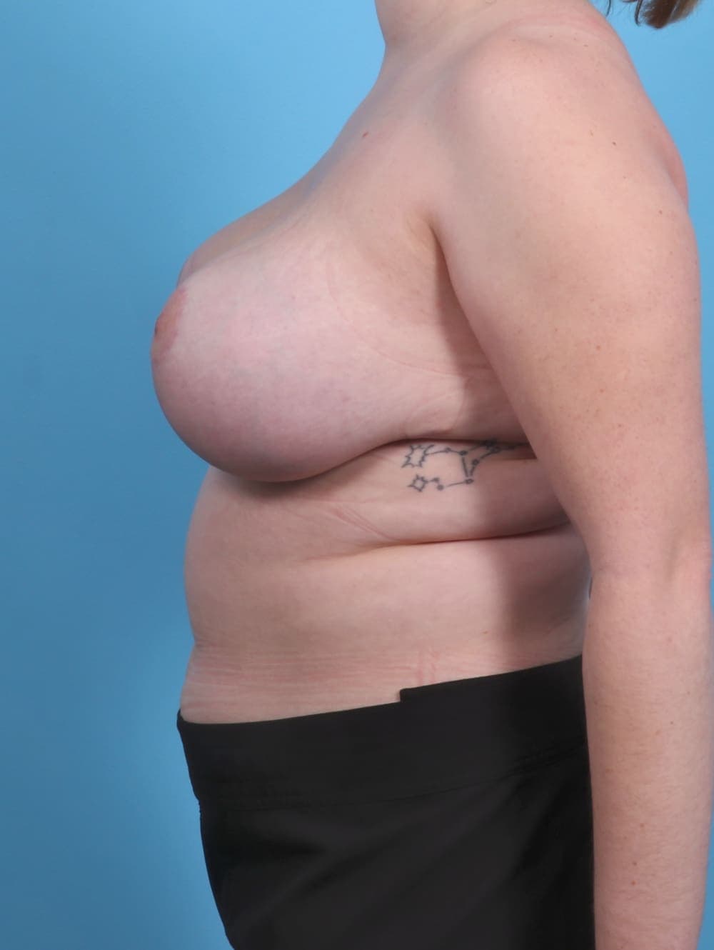 Breast Lift/Reduction case #4057 after, image 3
