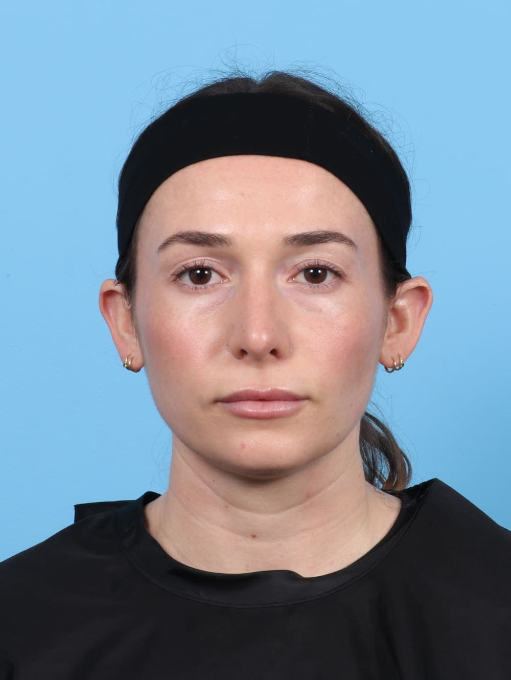 Rhinoplasty case #5325 after, image 2