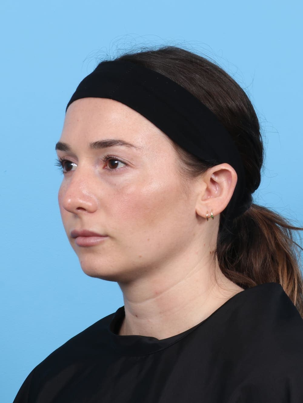 Rhinoplasty case #5325 after, image 3