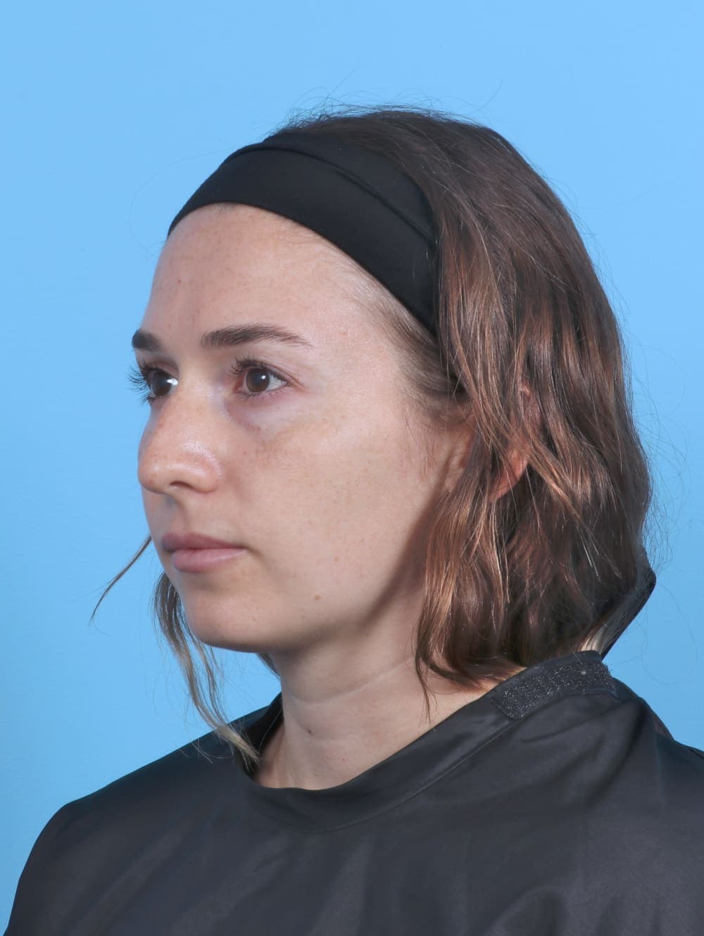 Rhinoplasty case #5325 before, image 3