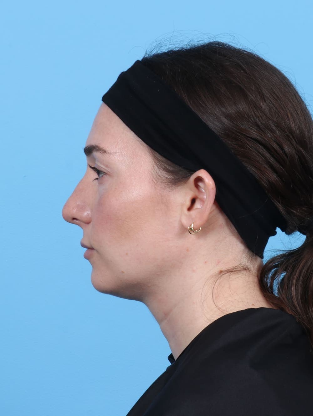 Rhinoplasty case #5325 after