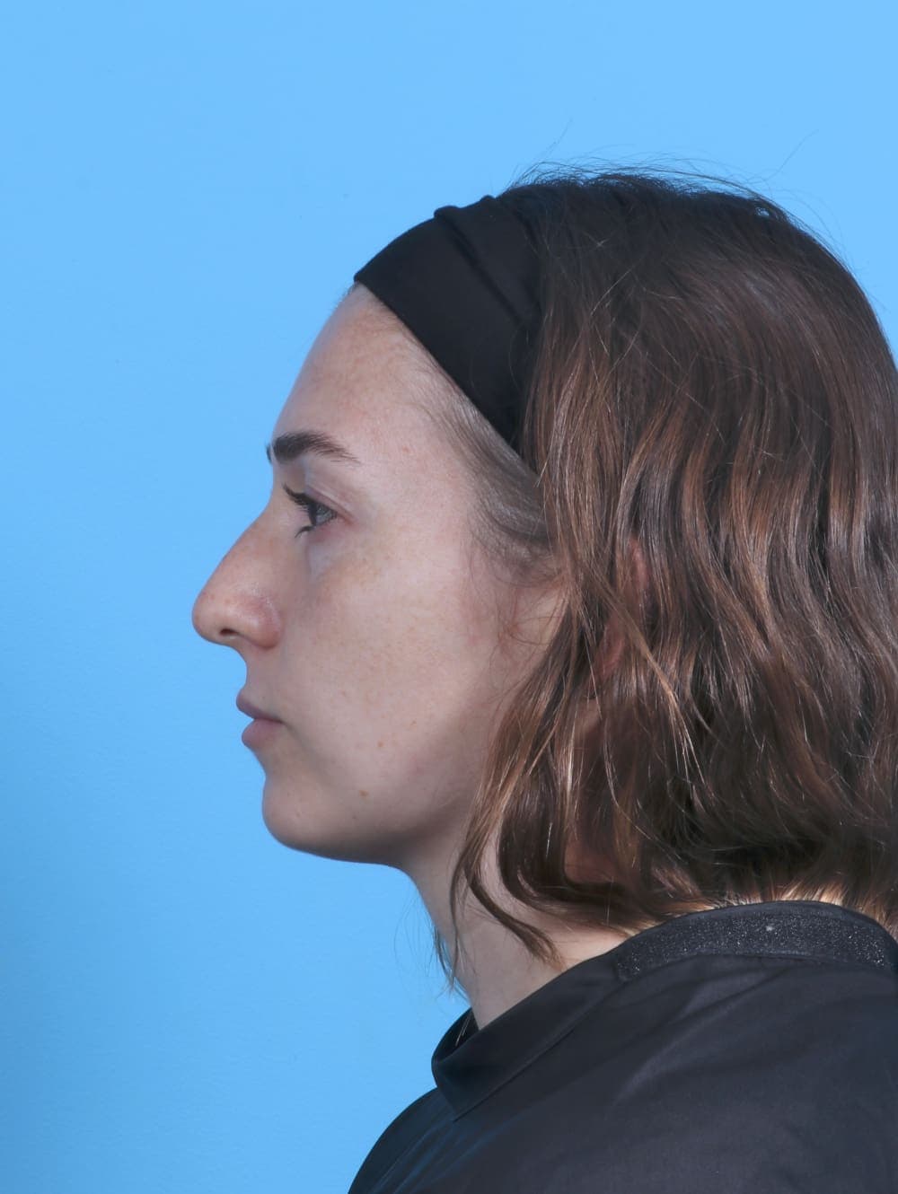 Rhinoplasty case #5325 before