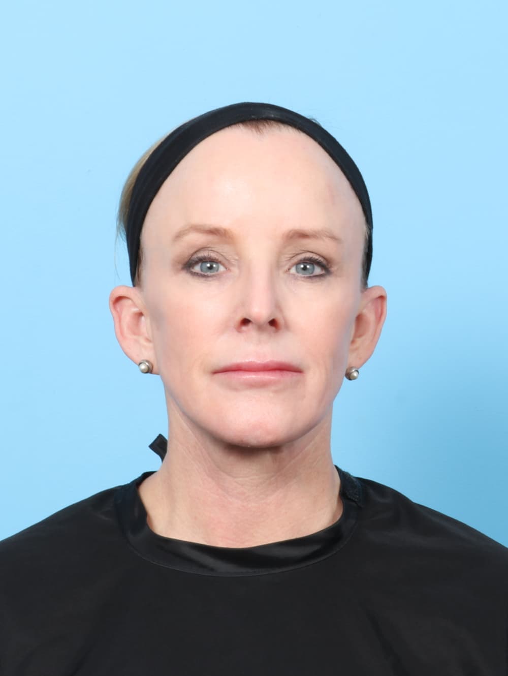 Eyelid Surgery case #7429 after