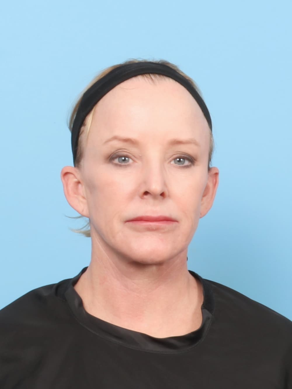Eyelid Surgery case #7429 before