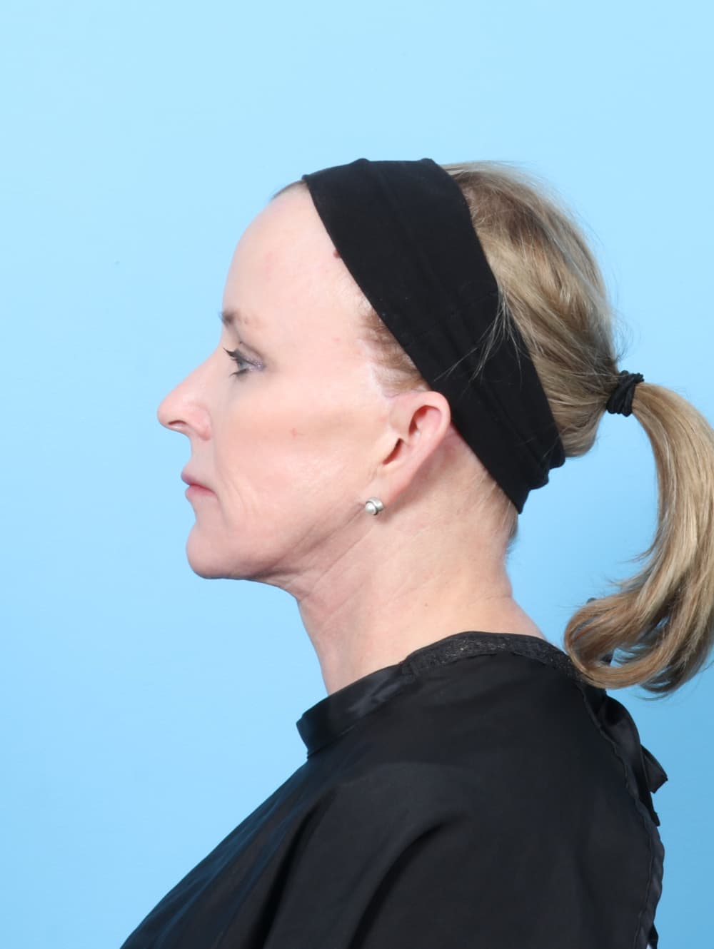 Eyelid Surgery case #7429 after, image 3