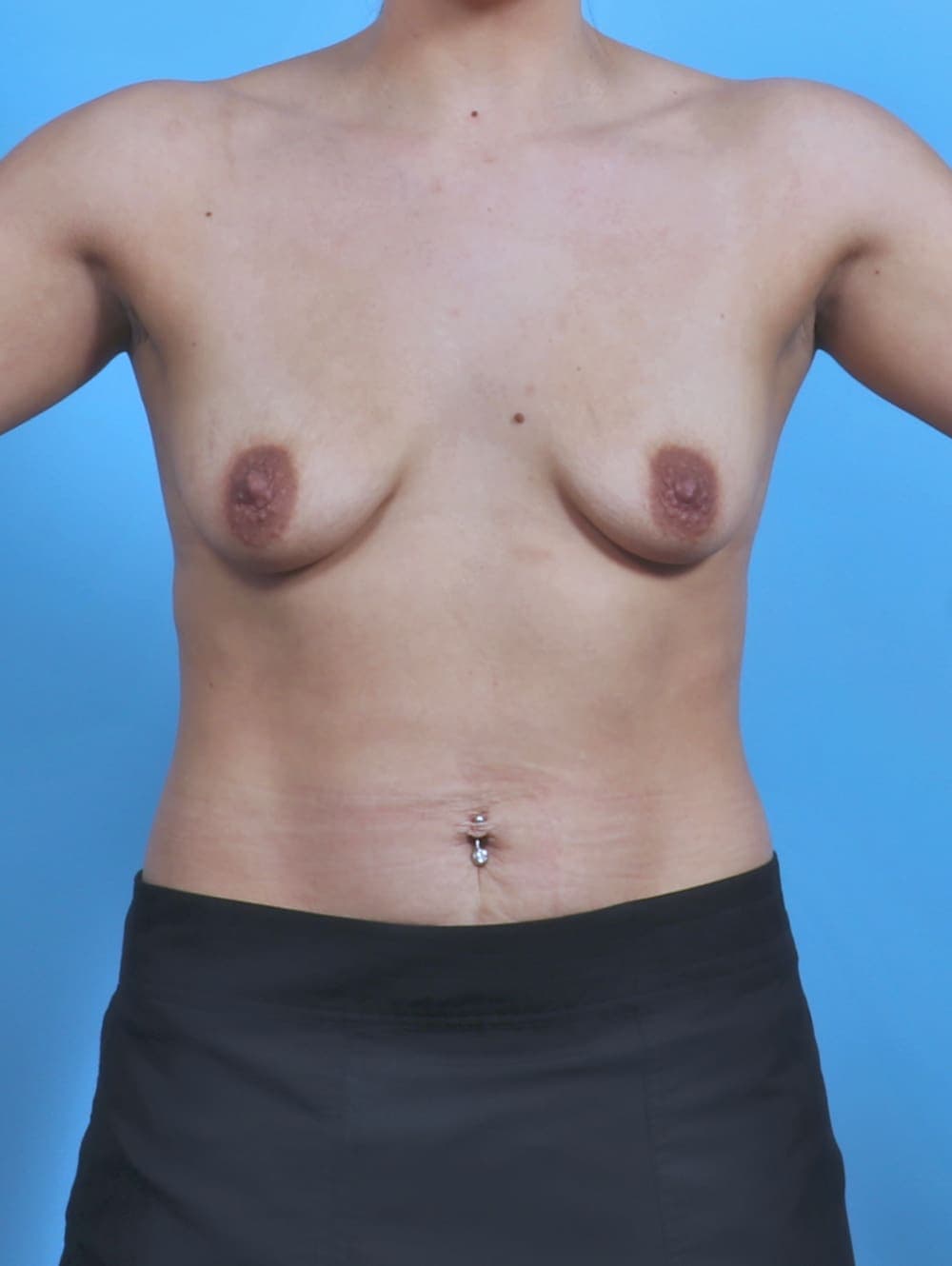 Breast Lift with Implants case #5560 before, image 1