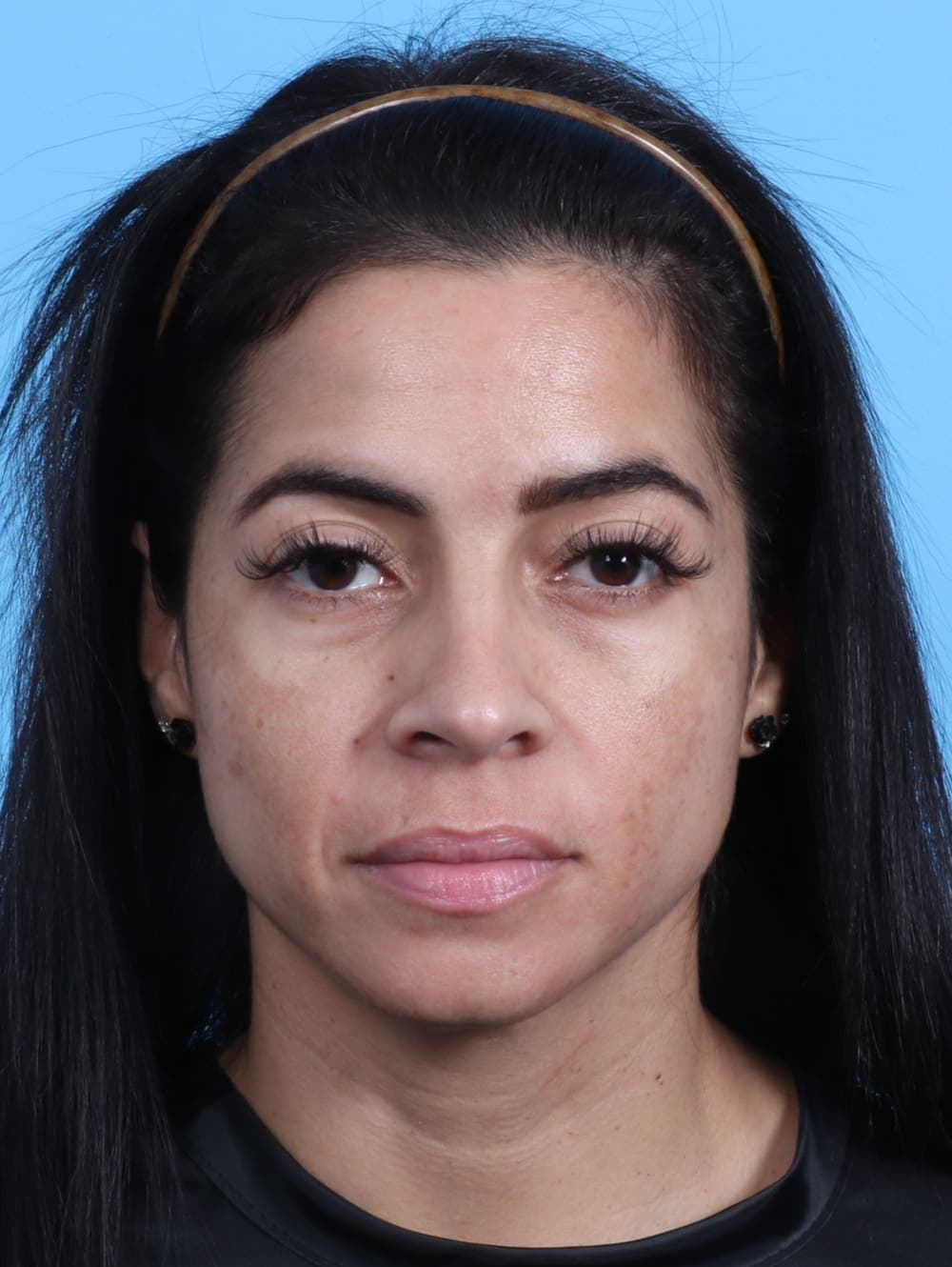 Rhinoplasty case #2771 after, image 2