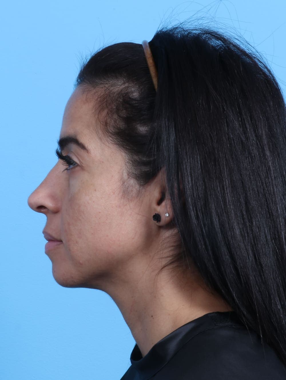 Rhinoplasty case #2771 after, image 1