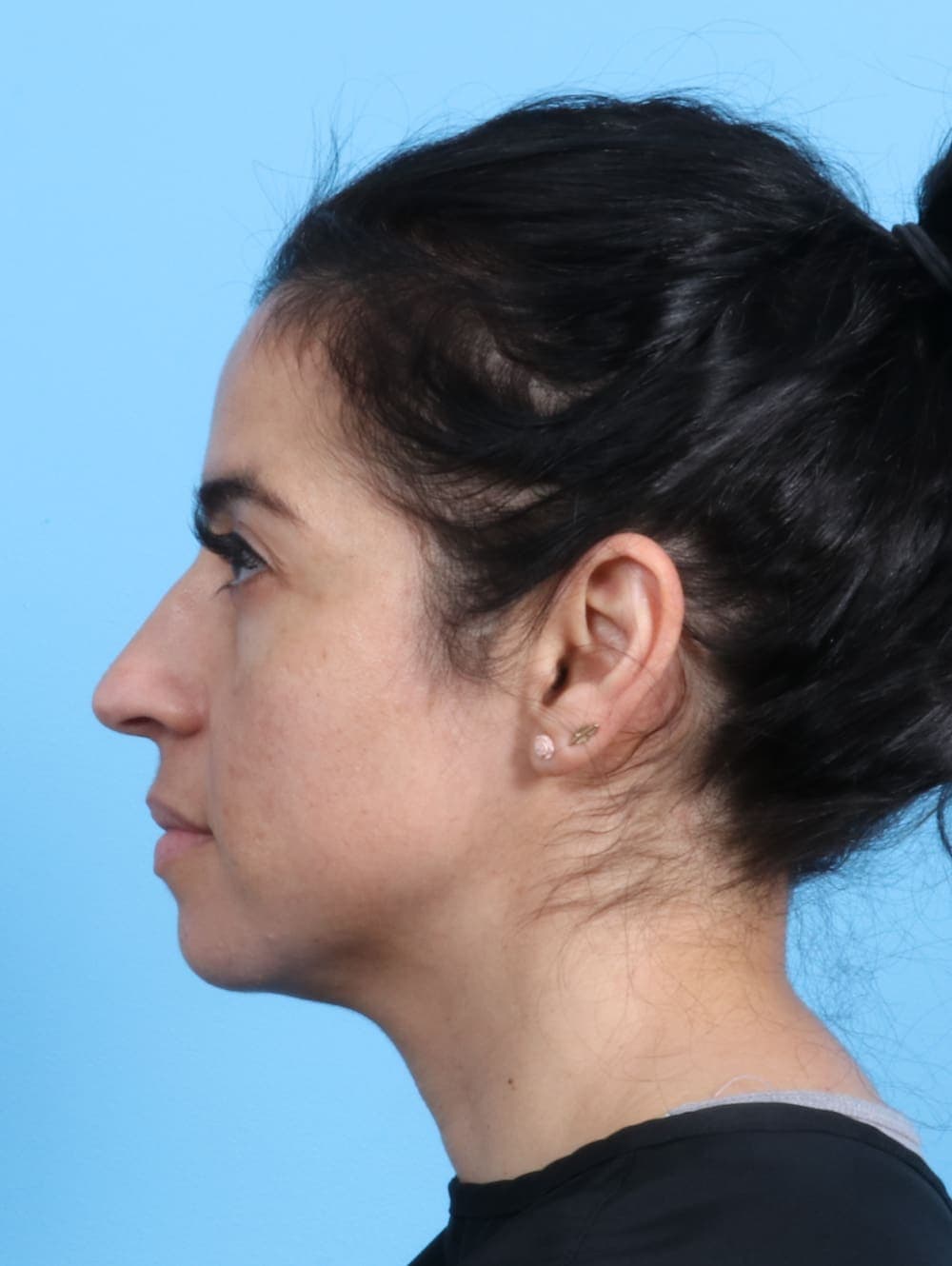 Rhinoplasty case #2771 before, image 1
