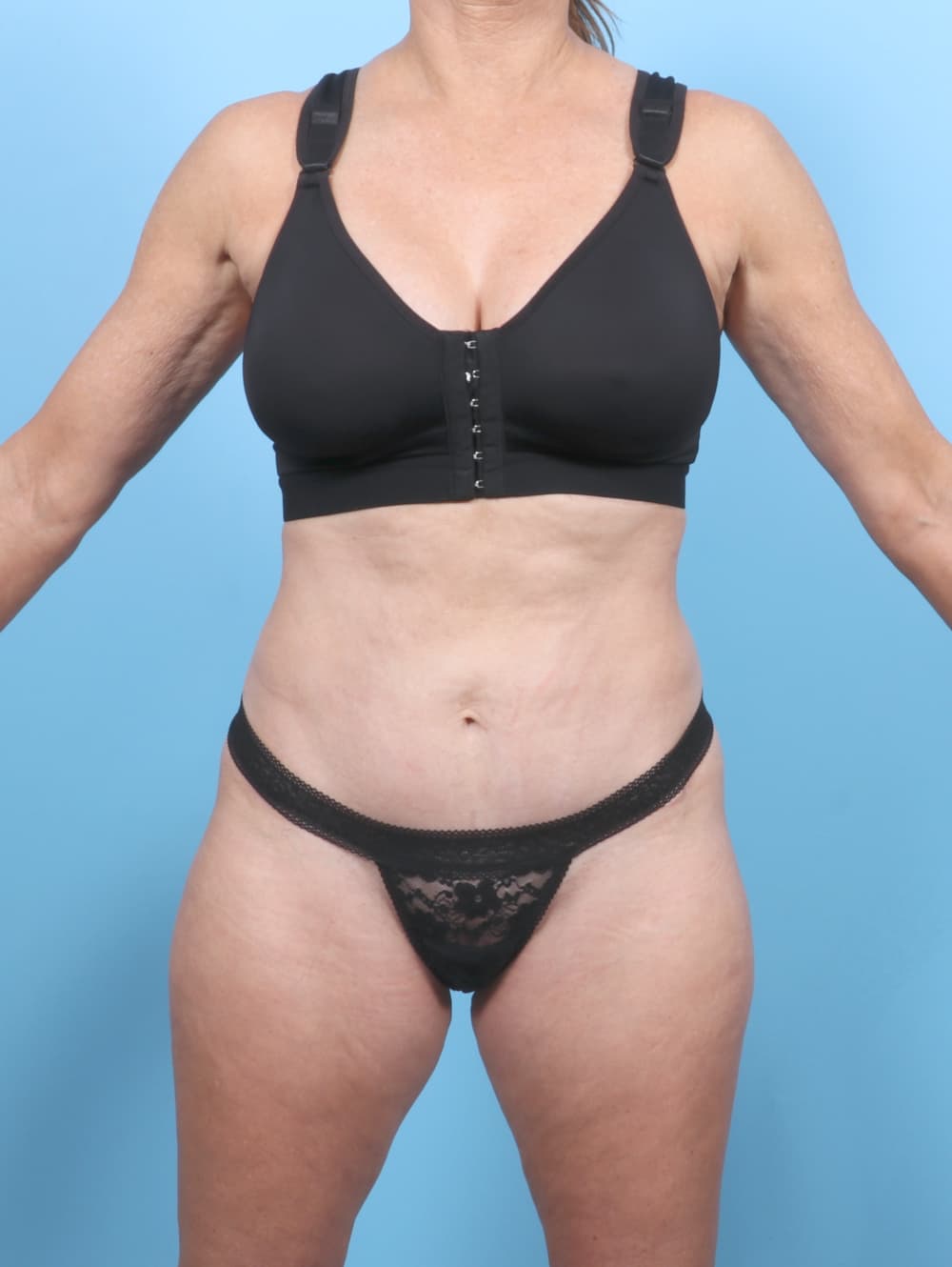 Tummy Tuck case #7323 after, image 1