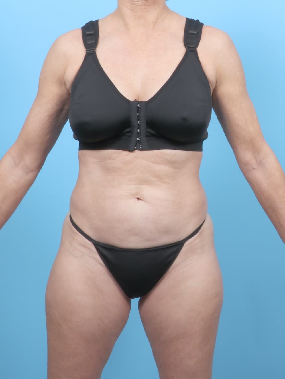 Tummy Tuck case #7323 before, image 1