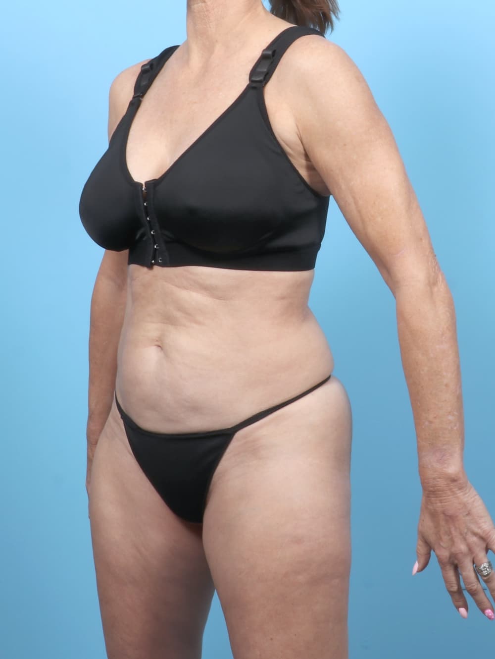 Tummy Tuck case #7323 before, image 2