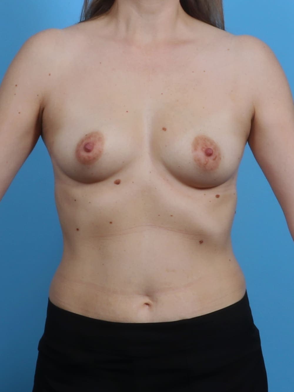 Breast Augmentation case #4203 before, image 1
