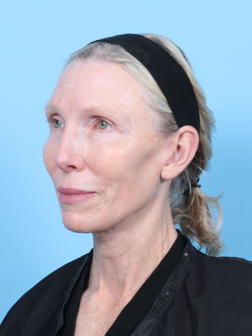 Facelift case #6725 after, image 2