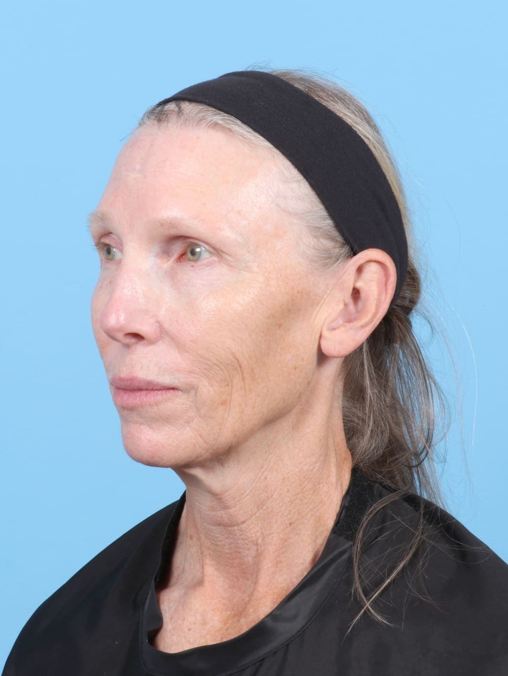 Facelift case #6725 before, image 2