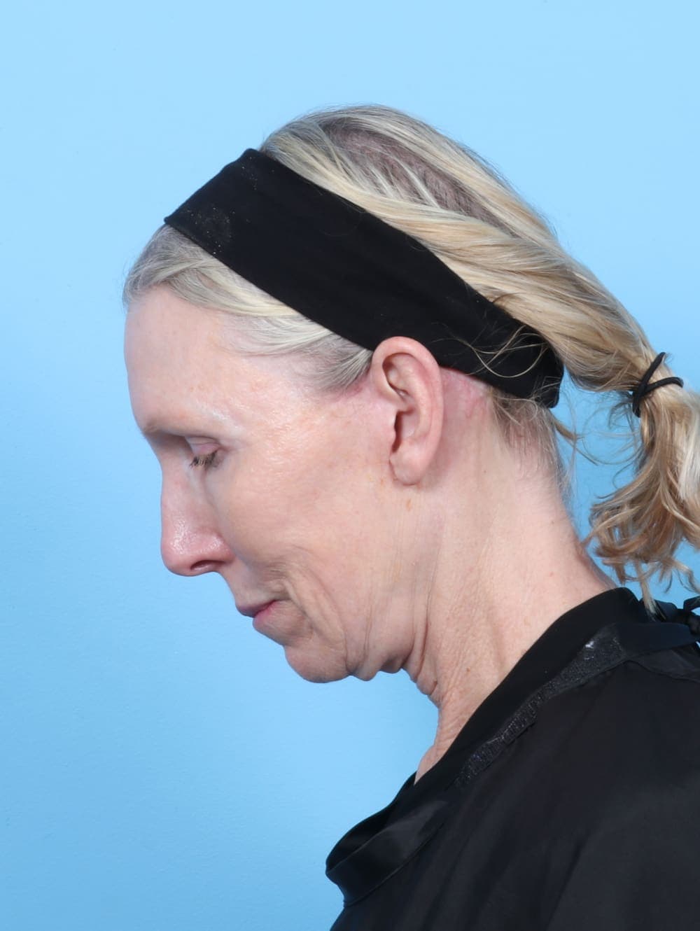 Facelift case #6725 after, image 4