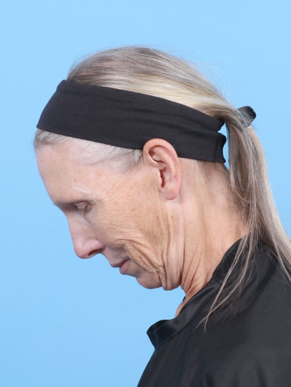 Facelift case #6725 before, image 4