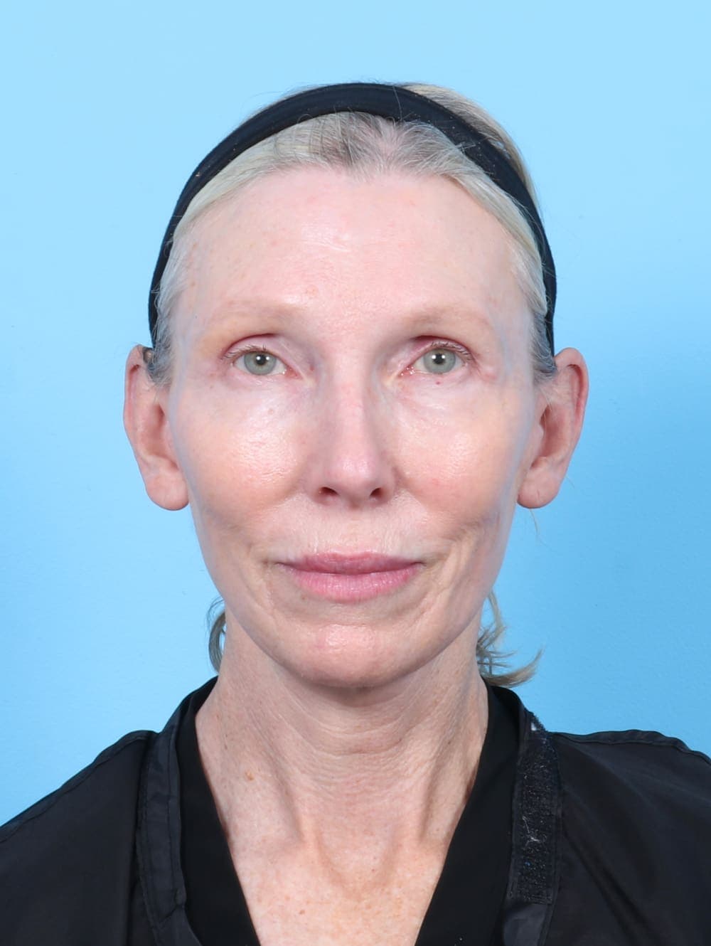 Facelift case #6725 after