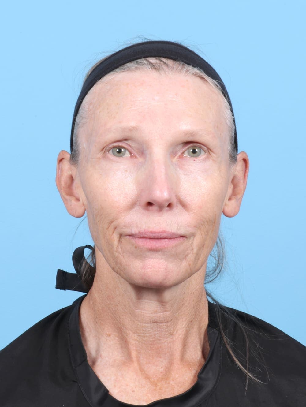 Facelift case #6725 before