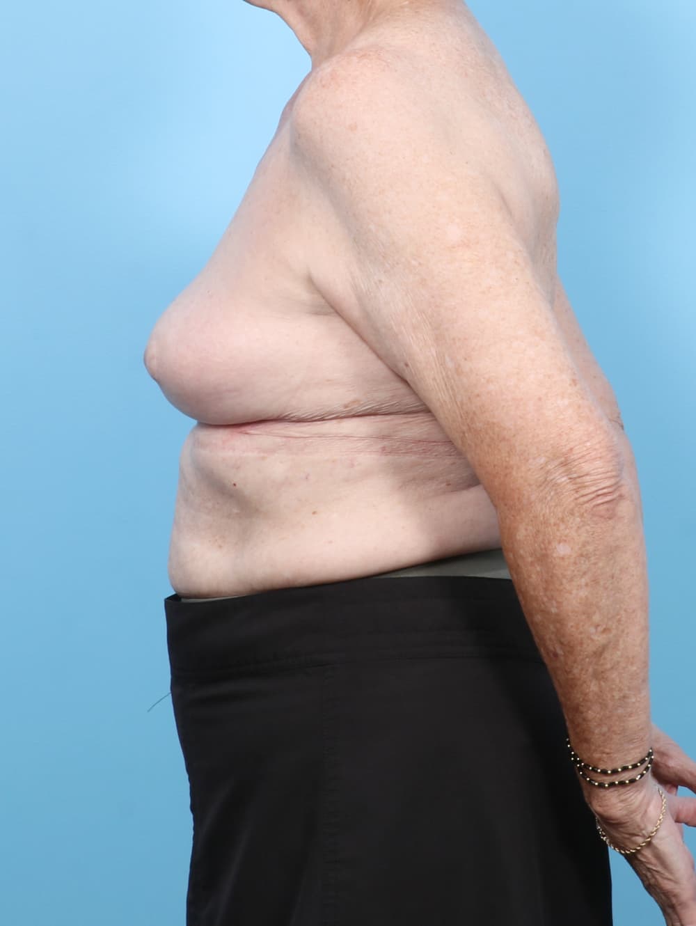 Breast Implant Removal with Lift case #7437 after, image 3