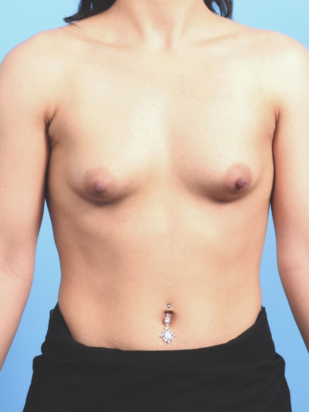Breast Augmentation case #2601 before, image 1