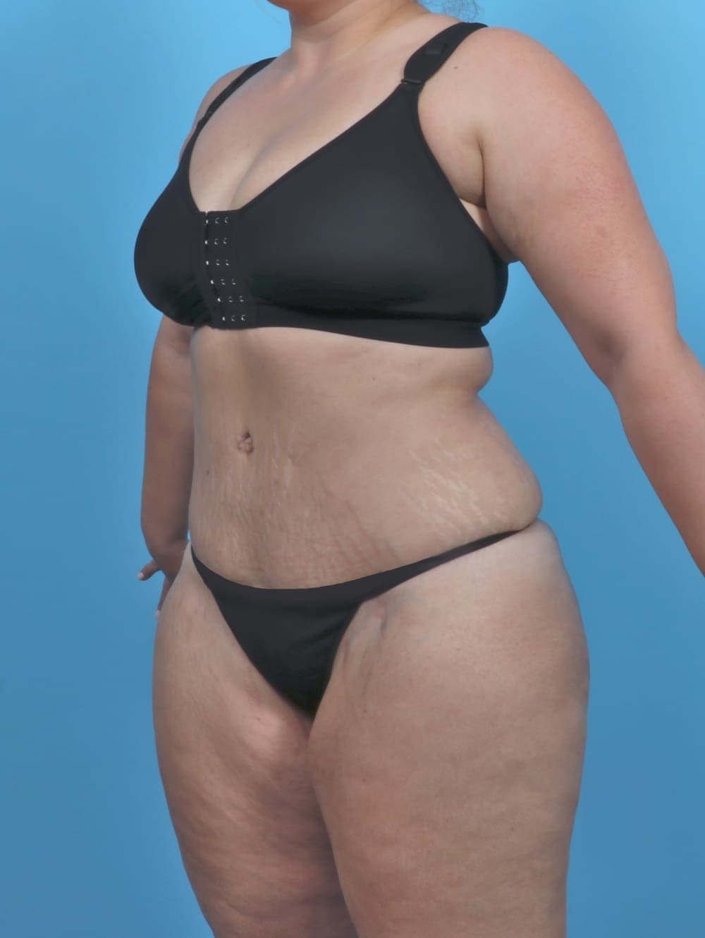Tummy Tuck case #4954 after, image 2