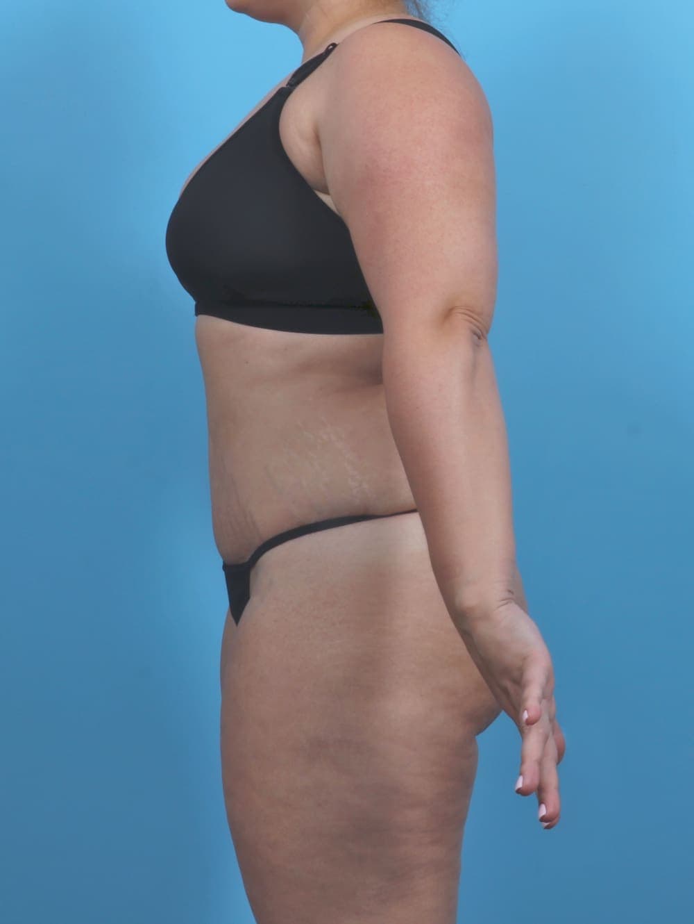 Tummy Tuck case #4954 after, image 3