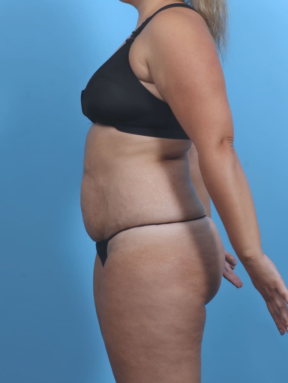 Tummy Tuck case #4954 before, image 3