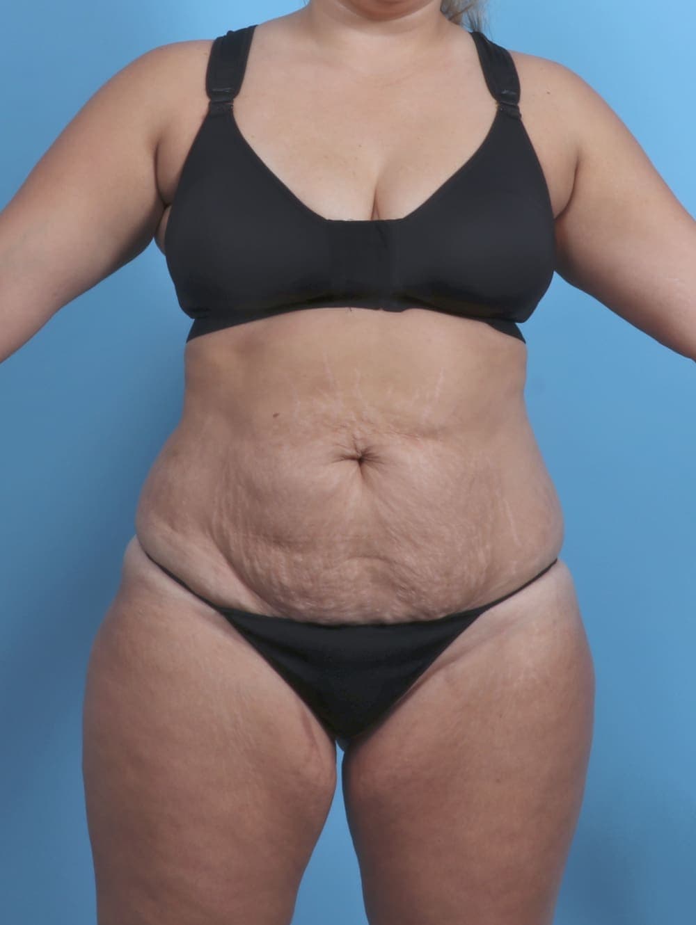 Tummy Tuck case #4954 before, image 1
