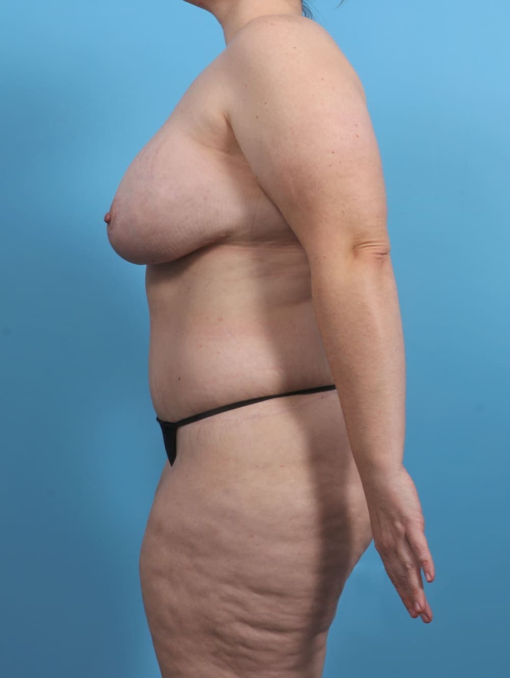 Body Lift case #4533 after, image 3