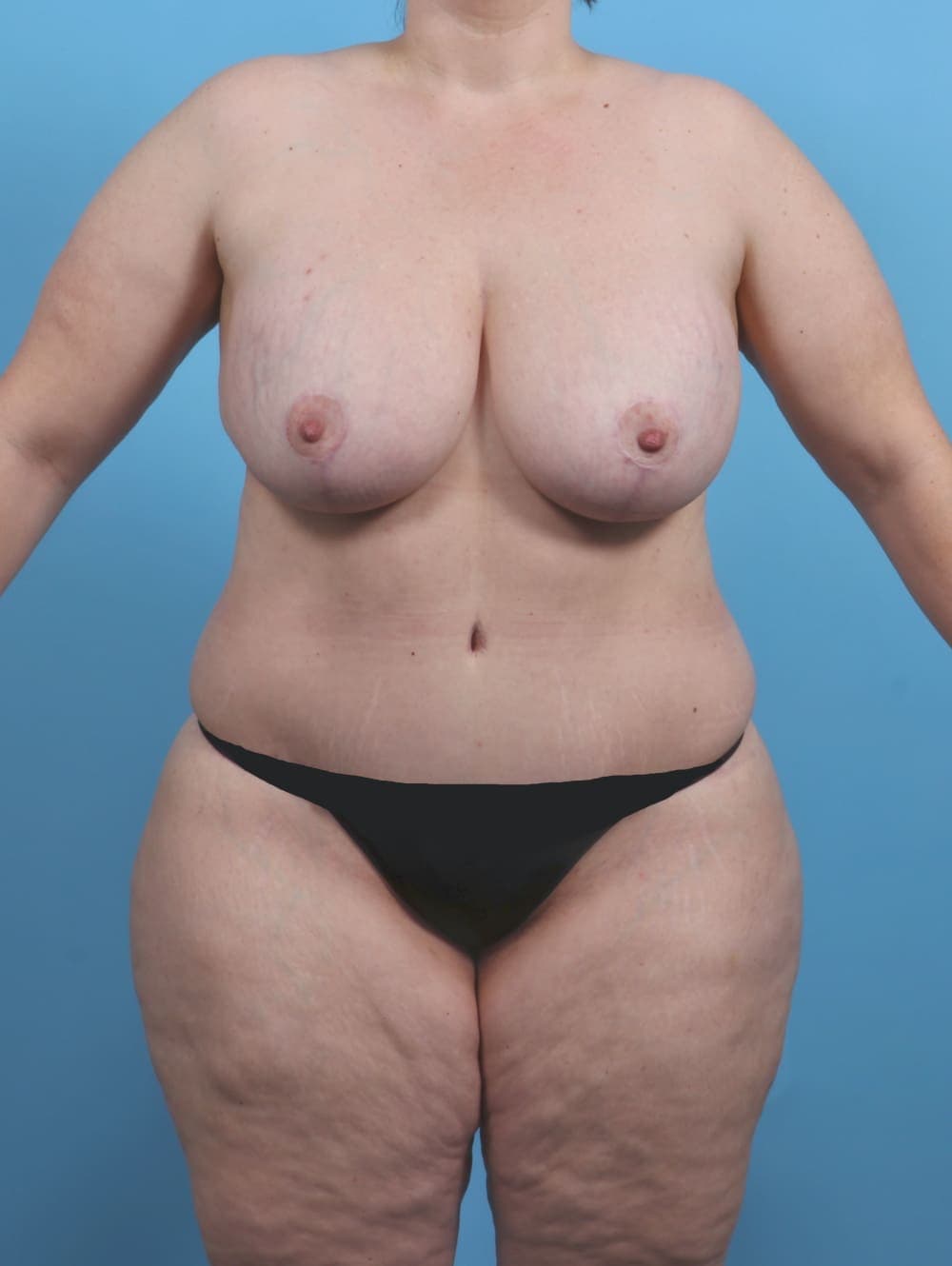Body Lift case #4533 after, image 1