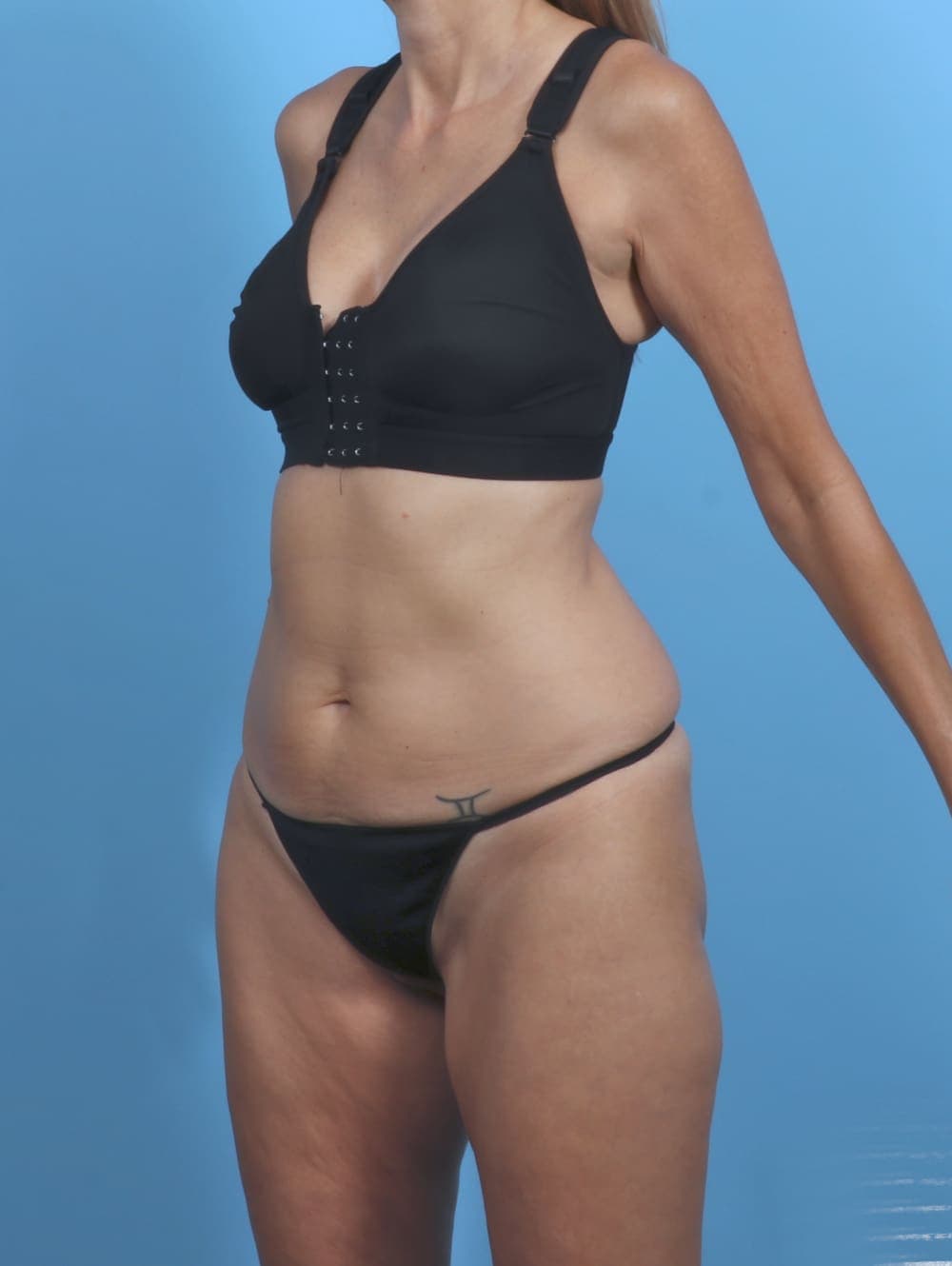 Tummy Tuck case #5333 before, image 2