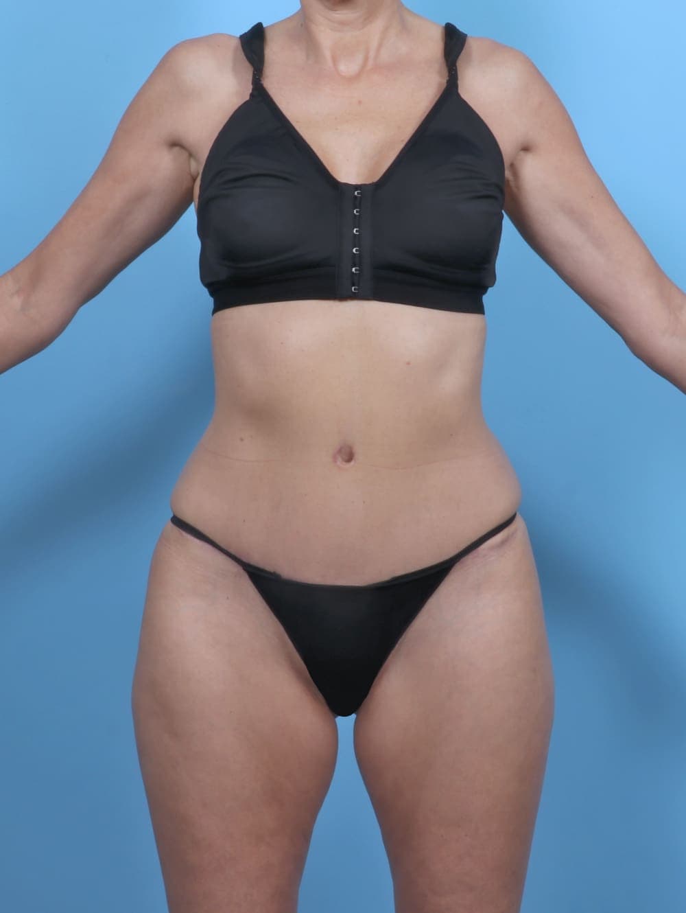 Tummy Tuck case #5333 after, image 1