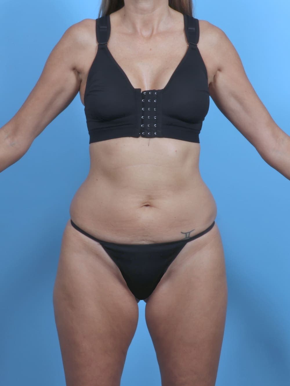 Tummy Tuck case #5333 before, image 1