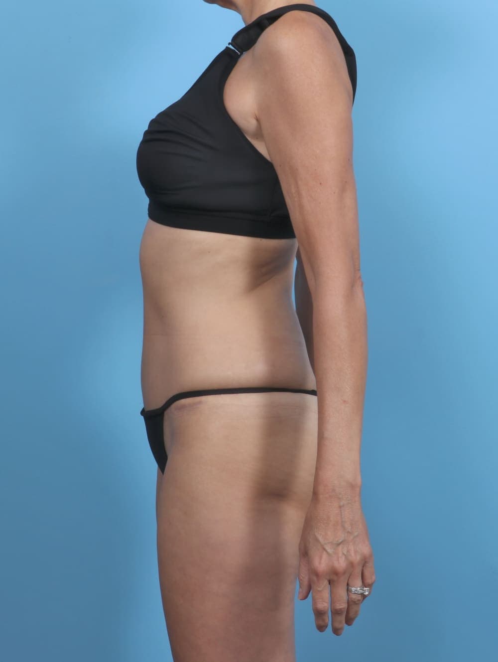 Tummy Tuck case #5333 after, image 3
