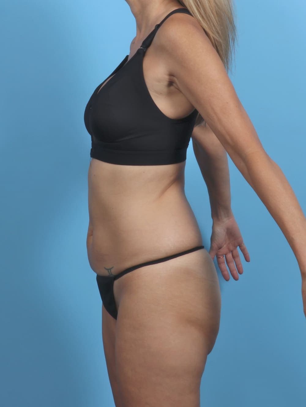 Tummy Tuck case #5333 before, image 3