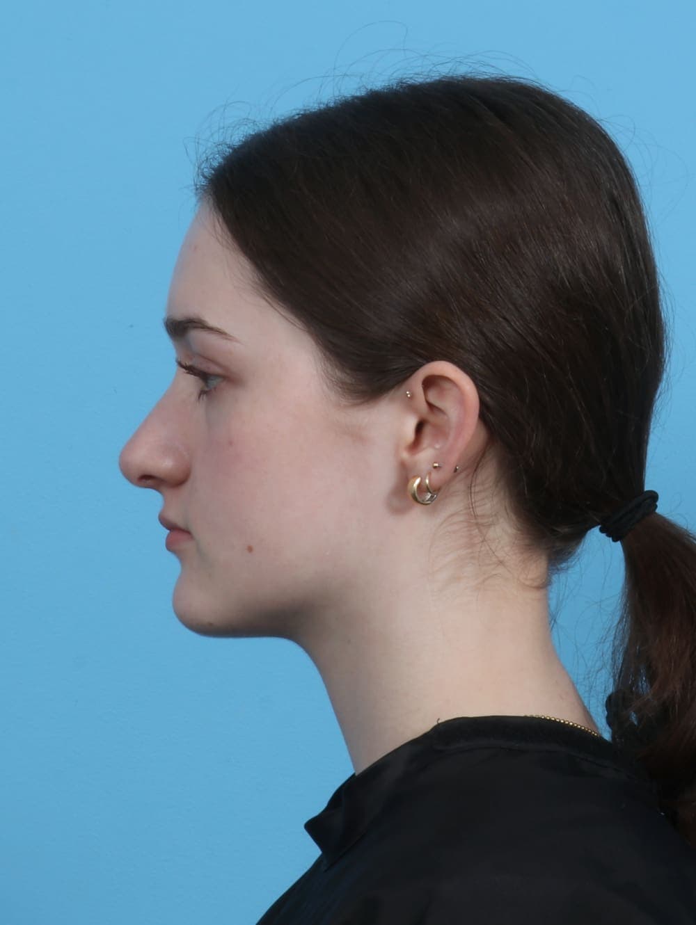 Rhinoplasty case #4481 after