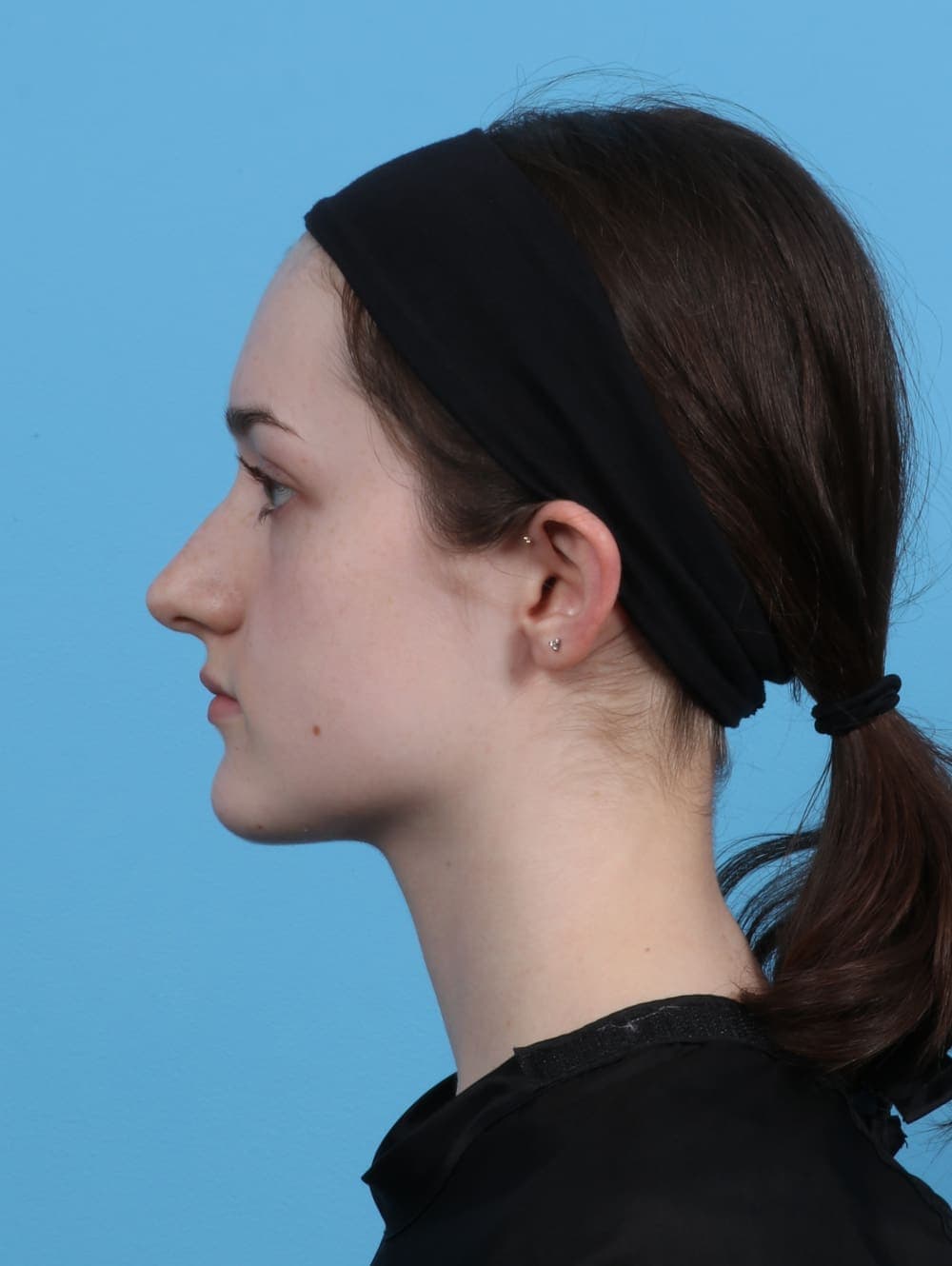 Rhinoplasty case #4481 before