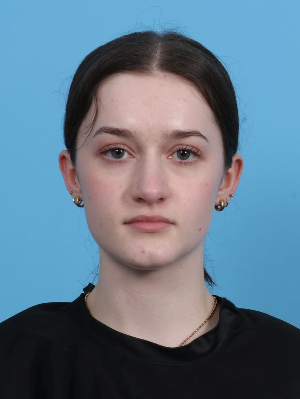 Rhinoplasty case #4481 after, image 2