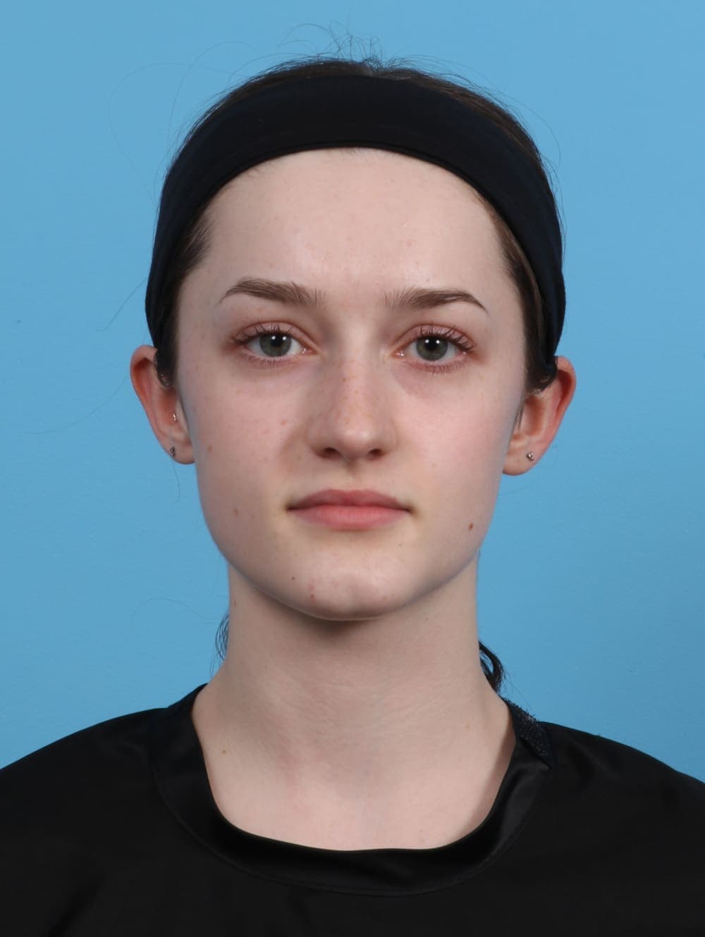 Rhinoplasty case #4481 before, image 2